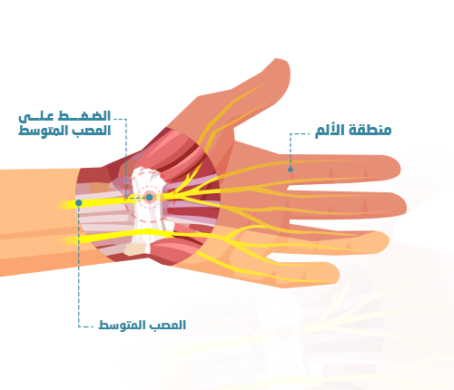  متلازمة النفق الرسغي